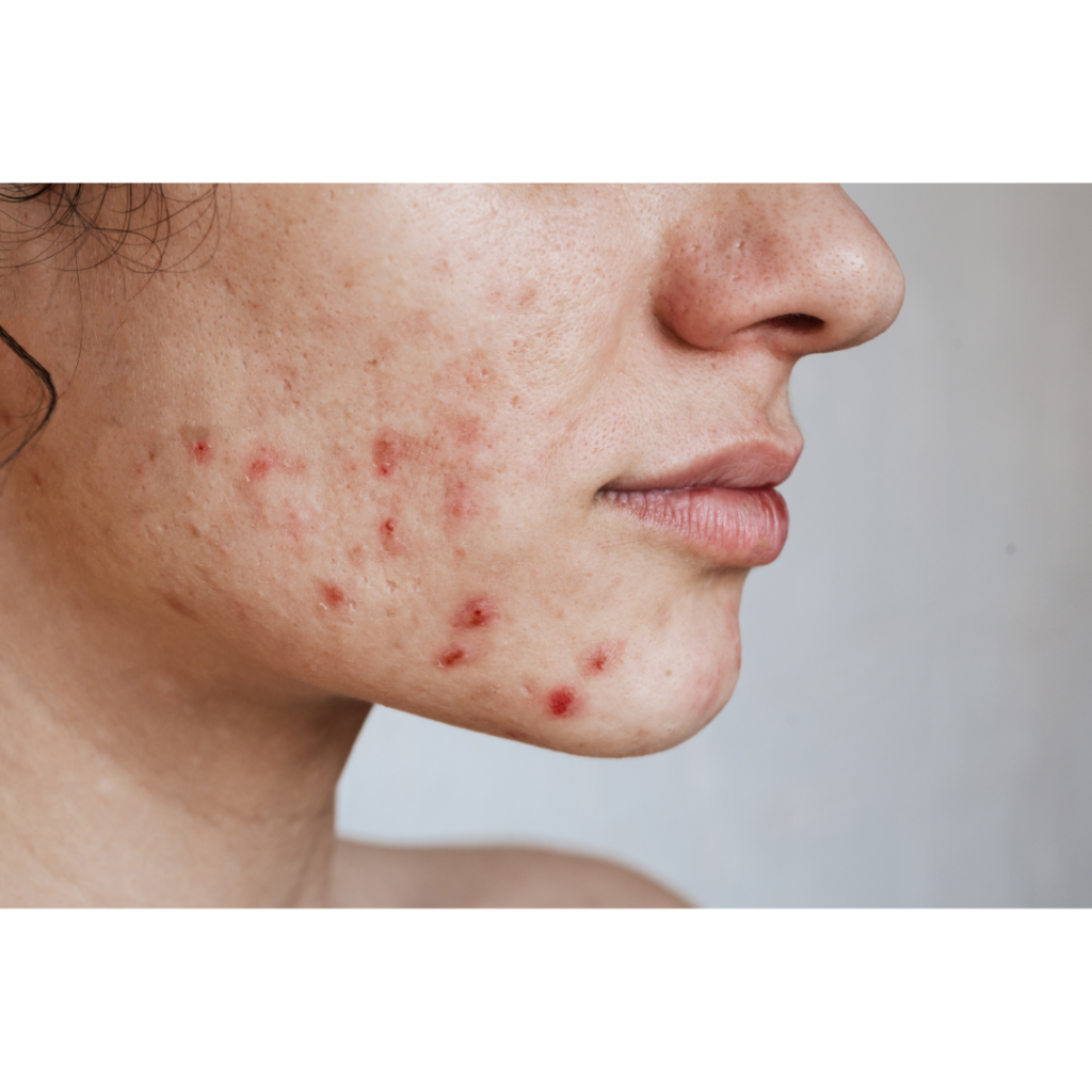 Understanding Acne Scars vs. marks